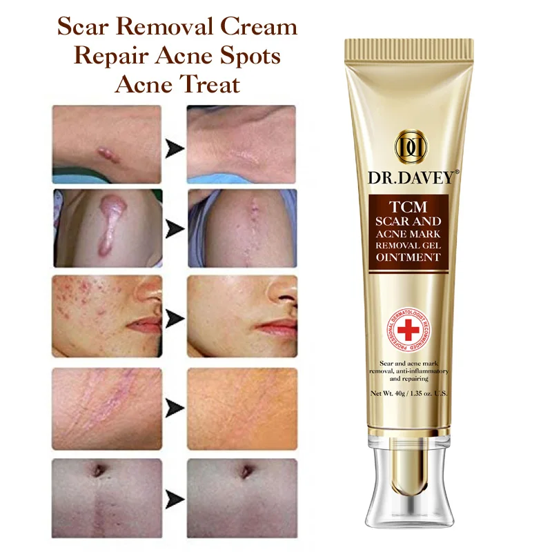 whitening gel ointment effectively removes scars and acne treatment gel