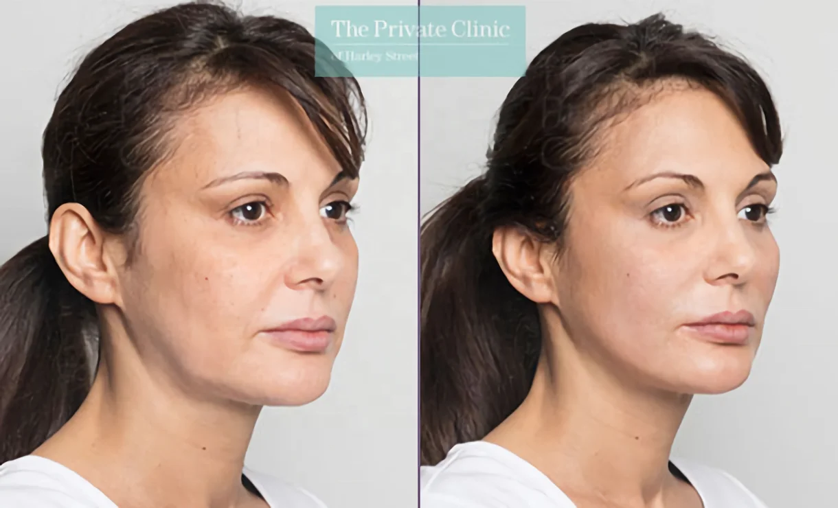 Резьба 4d Cog Pdo Fox Eyes Facelift использует впитываемую моно-винтовую резьбу Pcl