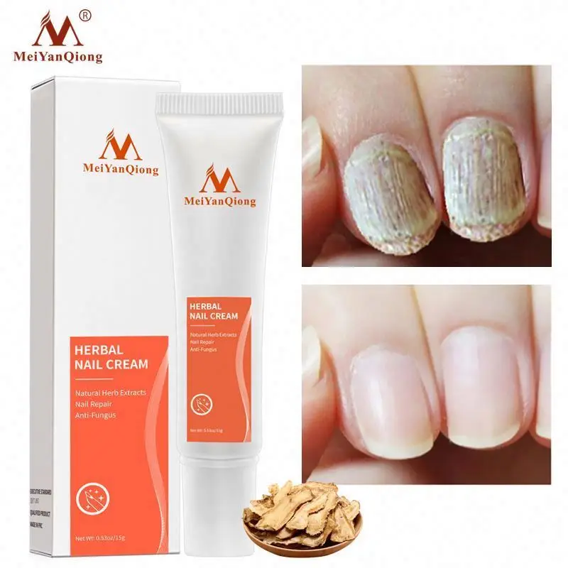 Discount OEM Meiyanqiong Chinese Herbal Treatment Onychomycosis Anti-fungal Nail Cream Discount OEM Meiyanqiong Chinese Herbal