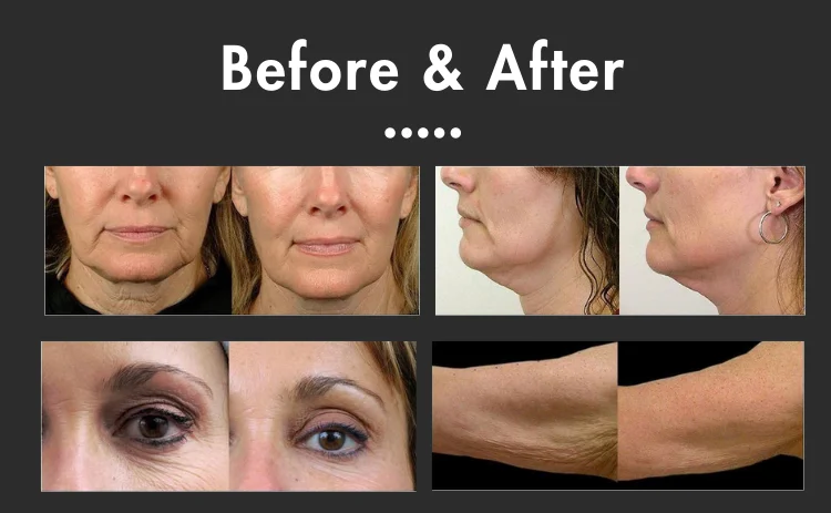 SVATAR 7d smas lifting tightening machine V Face Max Anti-aging Body weight loss and inch loss for beauty salon