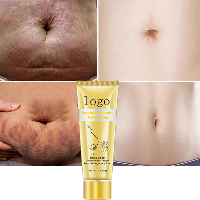 Pregnancy Stretch Mark Removal Cream Scar Stretch Marks Removal Gel