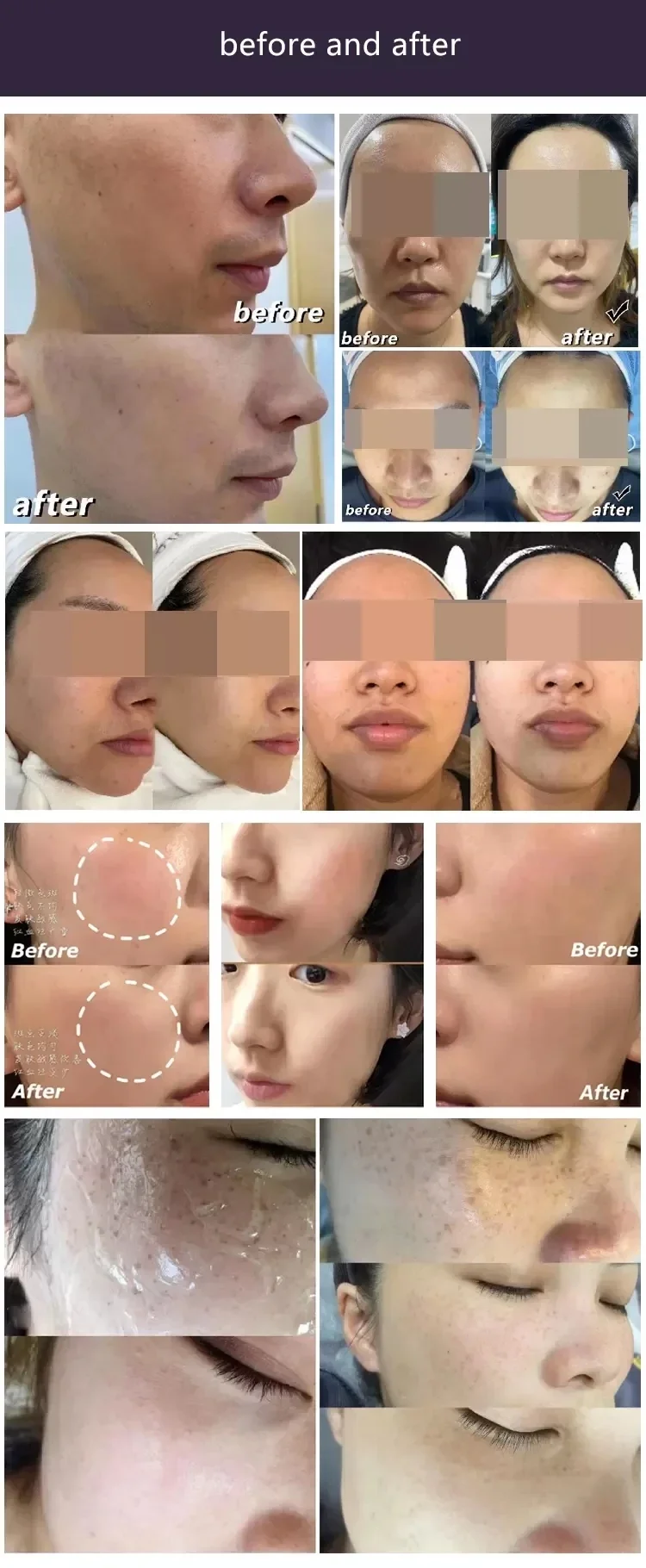 2024 Best selling High Frequency DPL Ultra Photon IPL Hair Removal Machine DPL Super Laser Skin Rejuvenation Machine