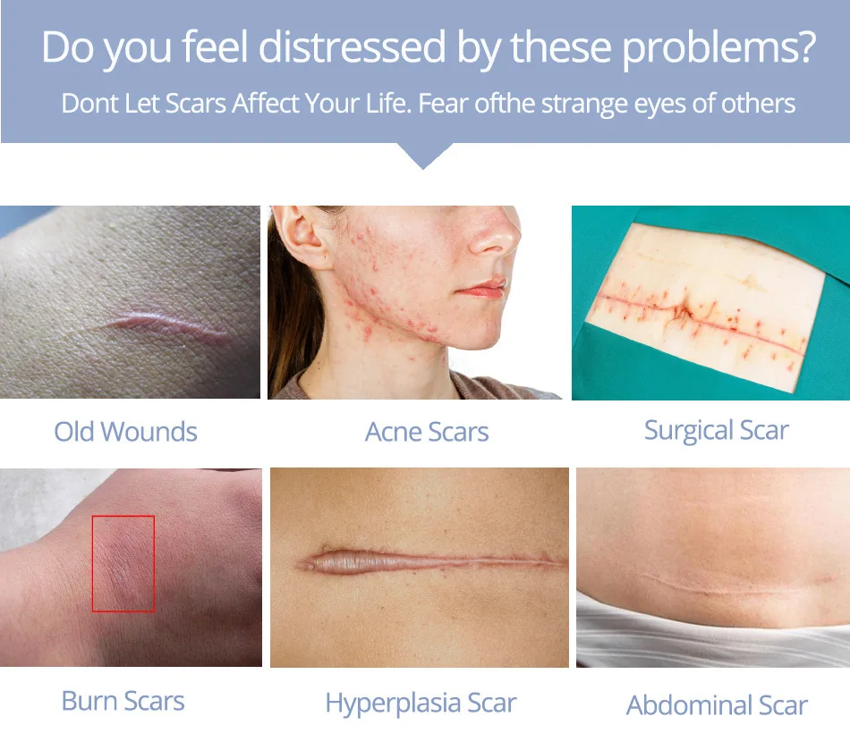 striae gravidarum cream