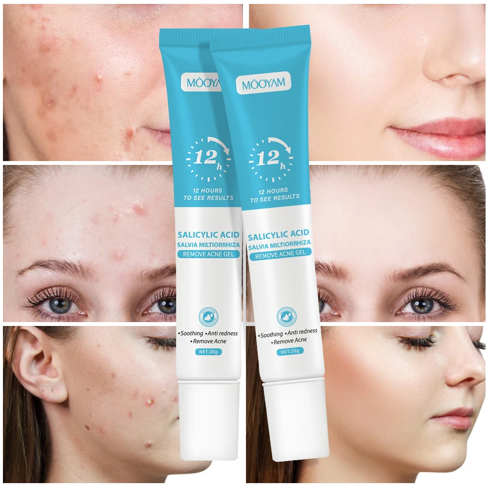 Fast Effective Repair Pimple Scar Anti Spots Removal Acne Gel Smooth Skin Shrink Pores Salicylic Acid Acne Treatment Cream