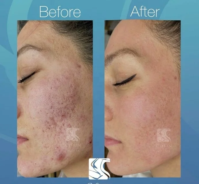 Stationary CO2 Fractional Laser Machine for Vaginal Skin Tightening and Scar Removal Laser Beauty Equipment