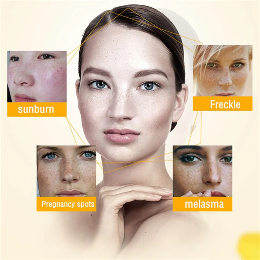 Effective Whitening Freckle Cream Remove Melasma Acne Spot Pigment Melanin Dark Spots Pigmentation Moisturizing Whitening Cream
