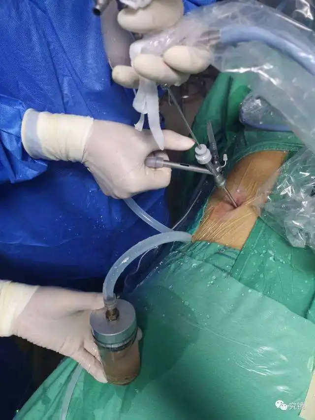 JS-1W (19Fr)Transcutaneous Nephroscope Surgical instruments Urology