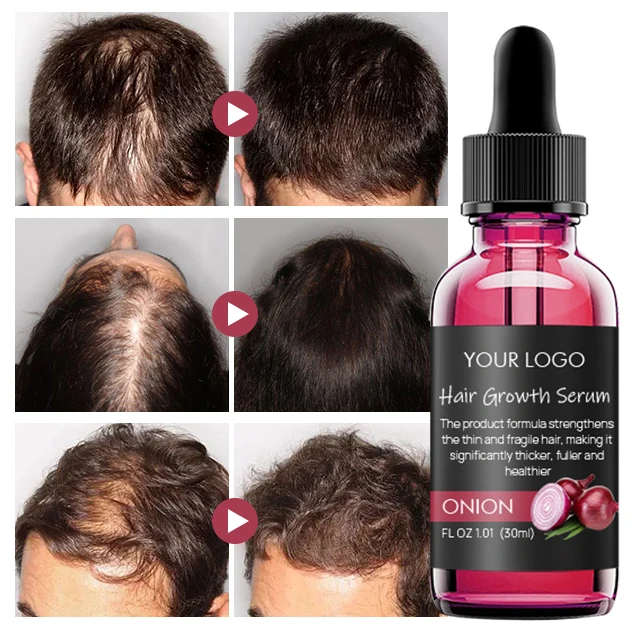 Private Label Organic Moisturizing Nourishing Anti Hair Lose Black Seed Red Onion Growth Oil Serum For Hair Growth
