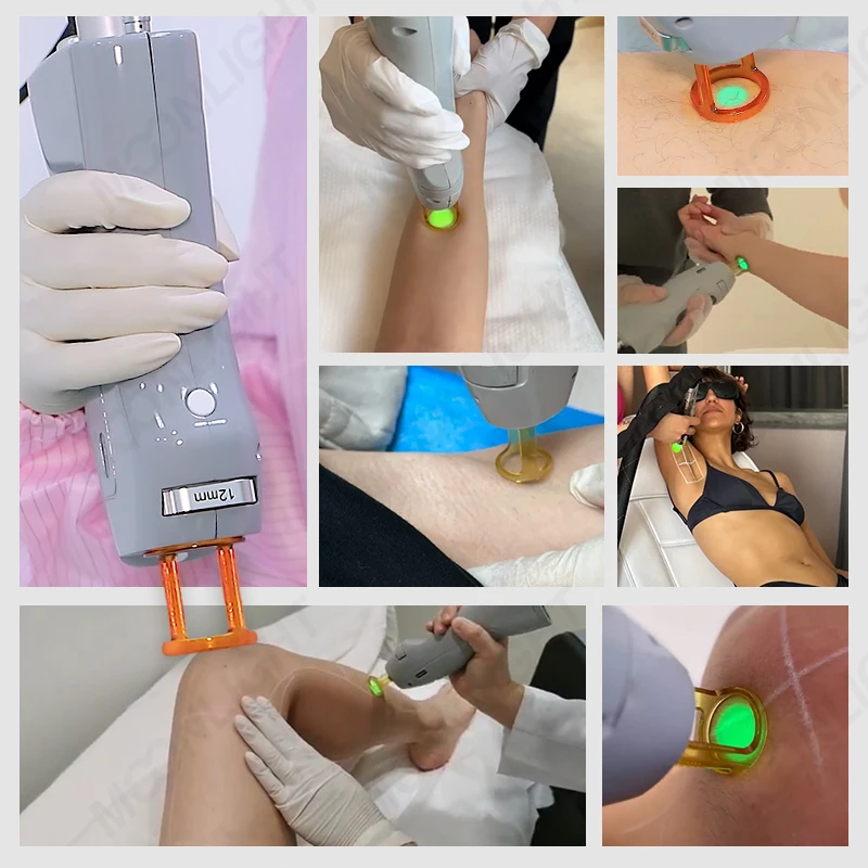 depilation quadro q-switch nd yag laser alexandrite beauty products hair removal machine for women