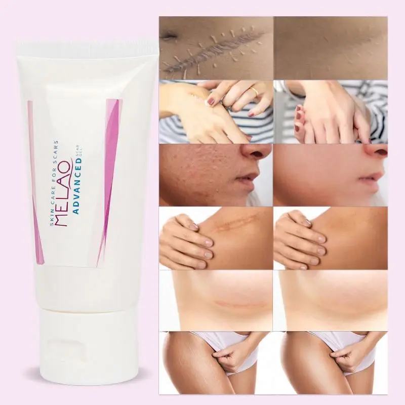 Gel oem private label free sample Scar and anti acne mark removal ointment silicone advanced Remover