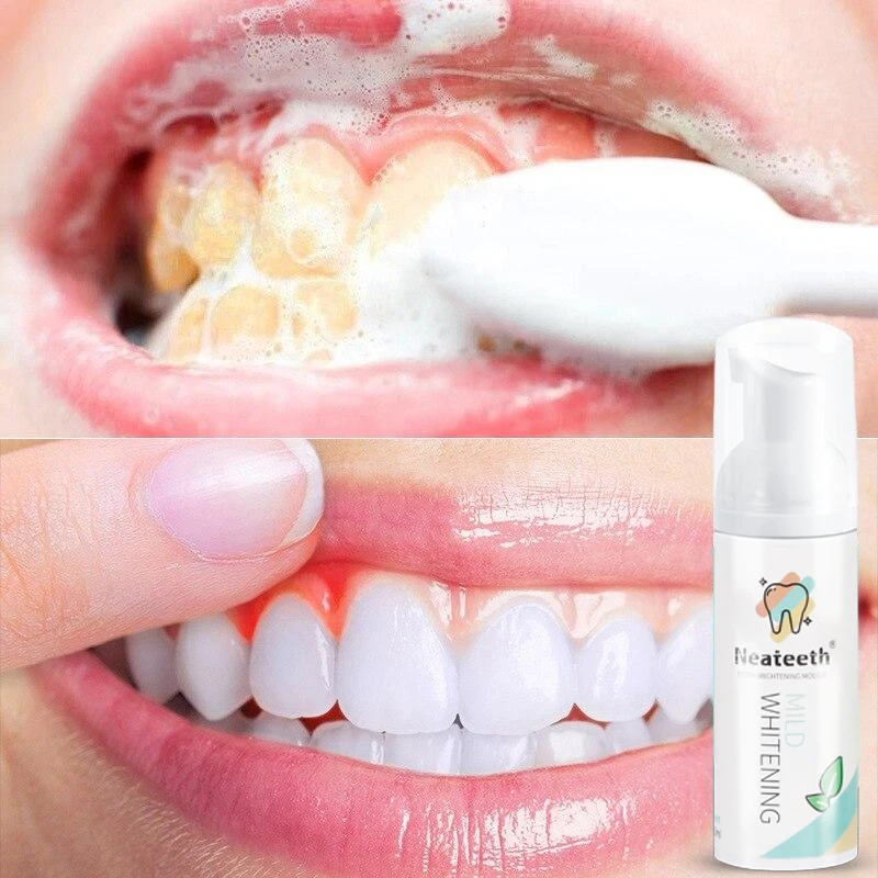 Hot Selling Stain Removal Aligner Retainer Cleaner Teeth Whitening Foam for Invisalign Dental Braces Mousse Toothpaste