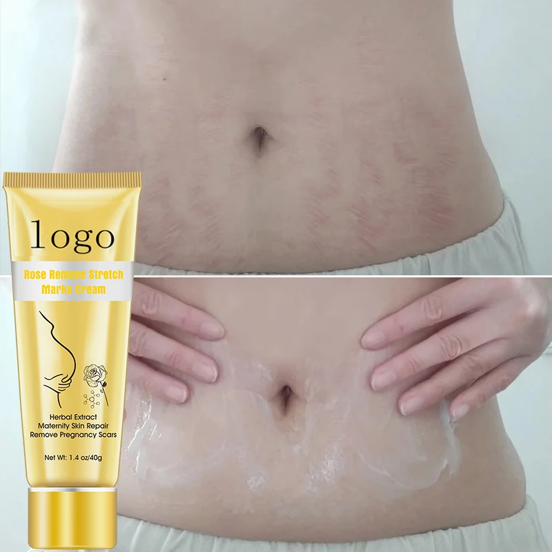 Pregnancy Stretch Mark Removal Cream Scar Stretch Marks Removal Gel