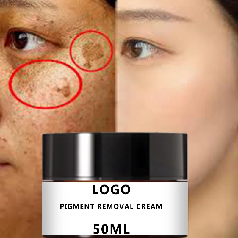 Organic vegan face body whitening brightening anti acne pimples cream corrector pigmentation removal dark spot removing cream