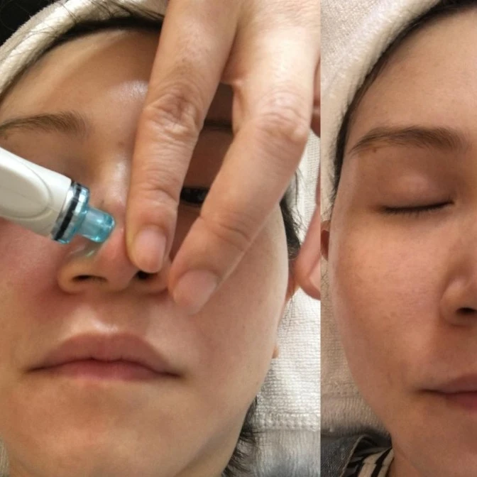 hydraface Hidrofacial Tips/Hydra Edge Dermabrasion MD Tips/Hydradermabrasion Disposable Tips Acuvue Hydraluxe