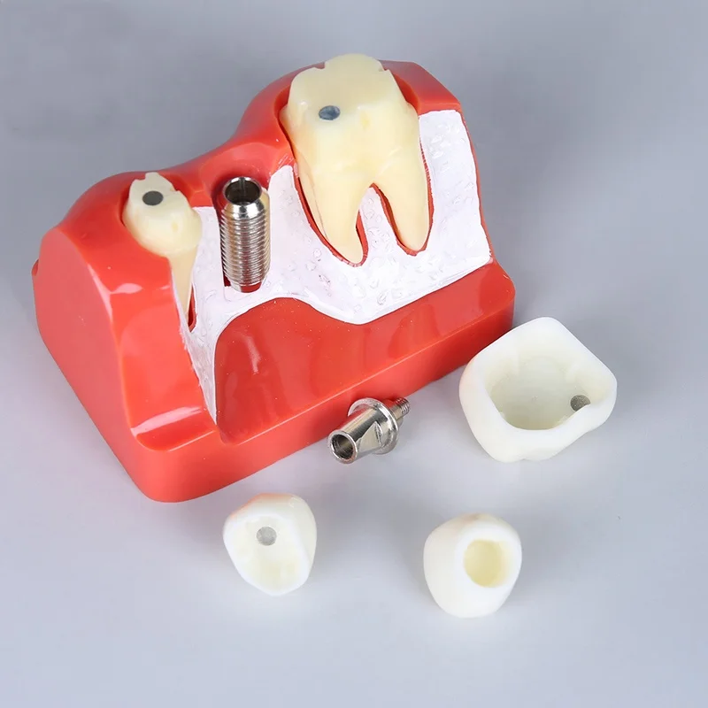Dental Teeth Caries Model Removable, Model Teeth for Dental Education Supplies, Tooth Pathology Display