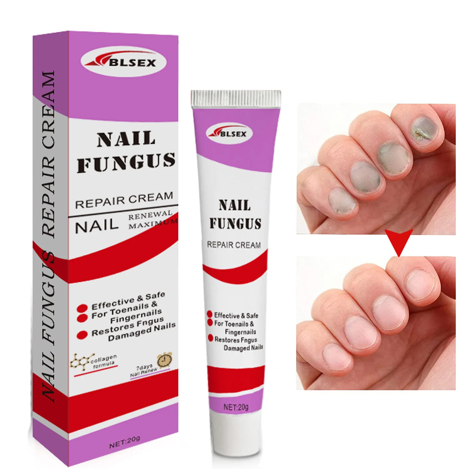 Nail Fungus Removal Cream Onychomycosis Fungal Nail Treatment Paronychia Anti Infection Feet Toe Fungal Nail Care Ointment