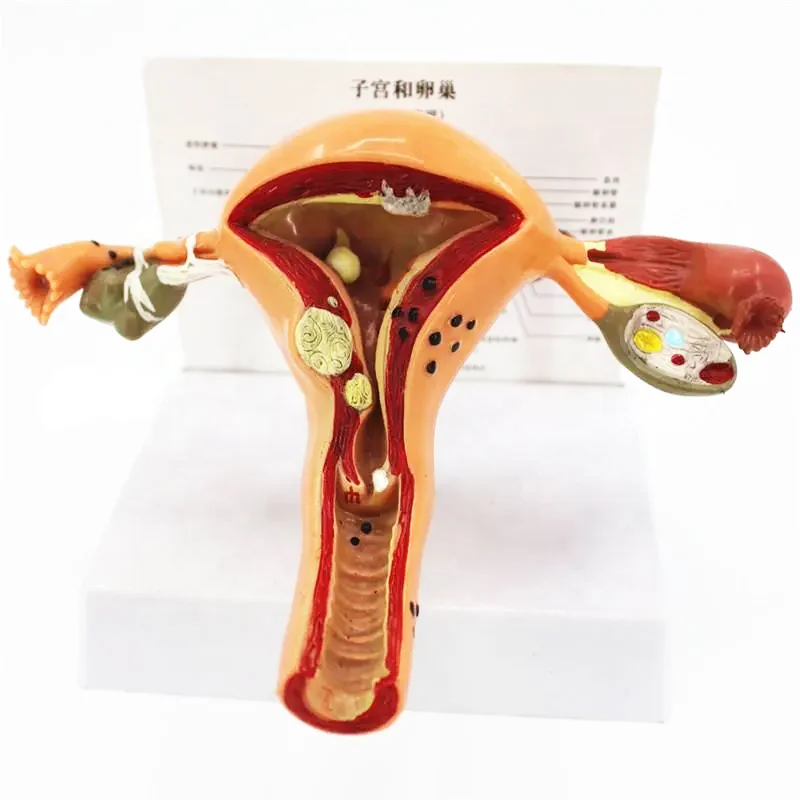 Модель патологической матки, медицинская женская модель для демонстрации