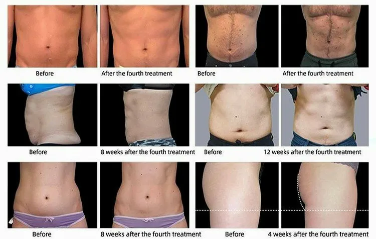 2021sincoheren the most hot selling ems machine body slimming shaping factory price and three years warranty