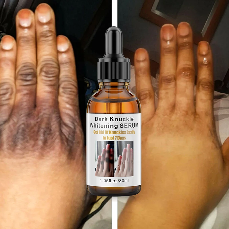 OEM Private Label Dark Knuckles Fast Whitening Serum Hand Knuckle Elbows Knee Intense Stains Remover Serum