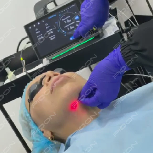 Pioon 1470nm Lipolysis Lipo Diode Laser Face Lifting Endolifting Laser Machine CE