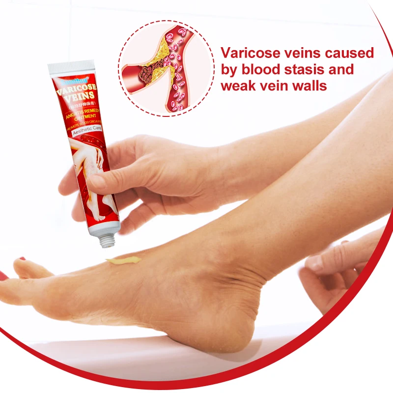 Sumifun New Varicose Veins Treatment Cream 100% Original Vasculitis Phlebitis Spider Pain Relief Ointment Medical Plaster
