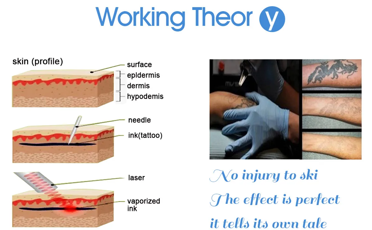 Nd Yag Q Switch Laser Machine  All Color Tattoo Removal & Carbon Peeling 1064 532 755