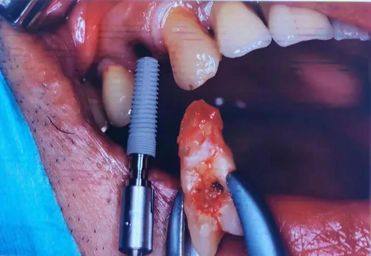 
Pure Titanium OEM Tooth Fixture Wego Dental Implant Chinese Factory Bone Level Tooth Root Morse Taper Micro-dual Thread Implant 