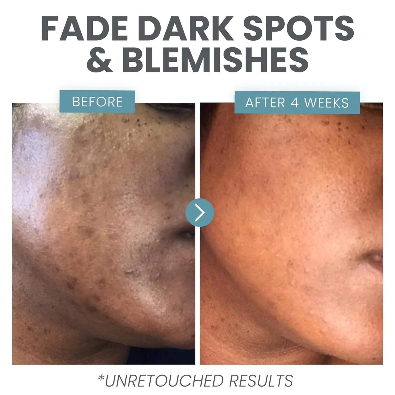 OEM Skin Clearing Brightening Acne Anti Aging Salicylic Acid Dark Spot Treatment Vitamin C Serum