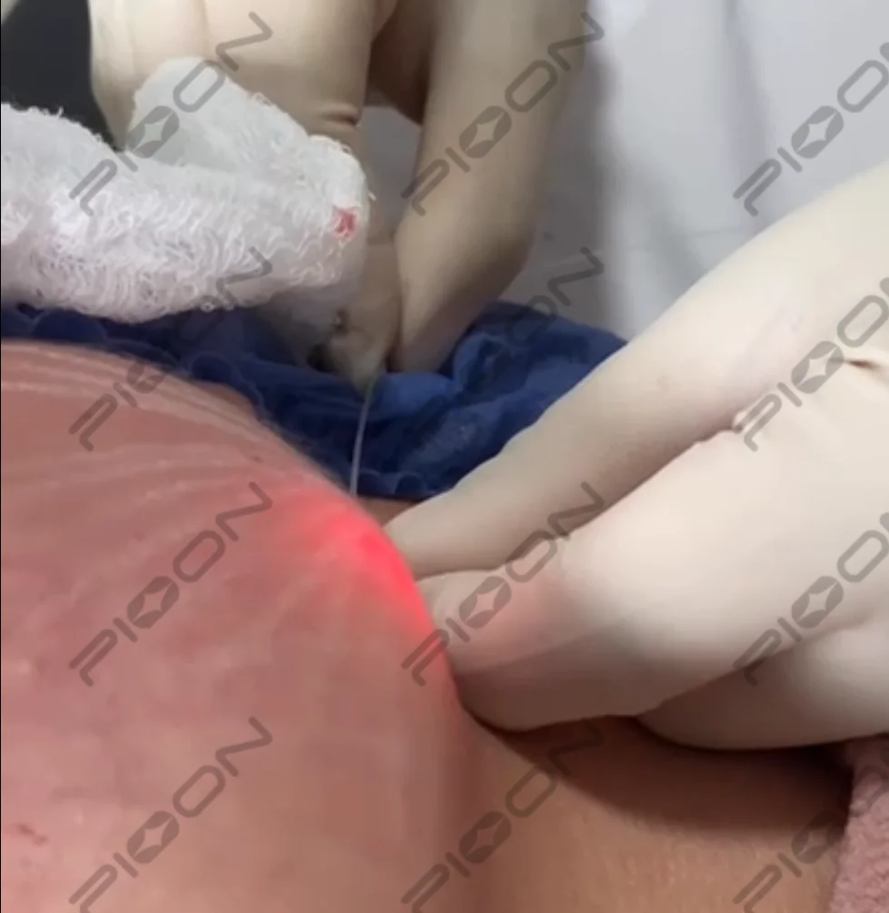 PIOON Endolifer1470nm 15W Diode Laser Liposuction Laser Machine Face Lifting Endolaser Compact and highly integrated