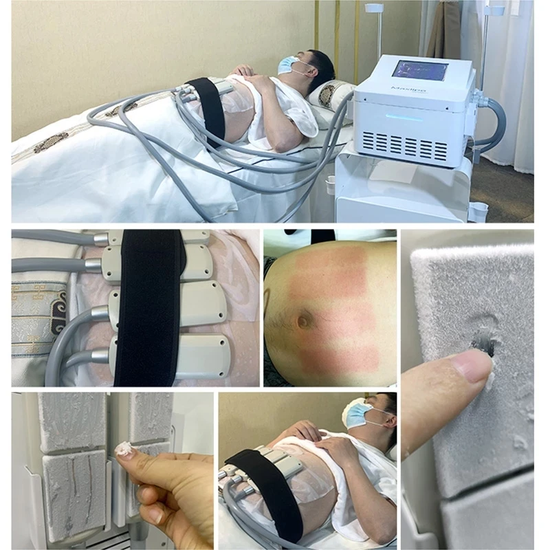 Cryotherapy cryolipolysis body slimming machine with 4 cryo pads