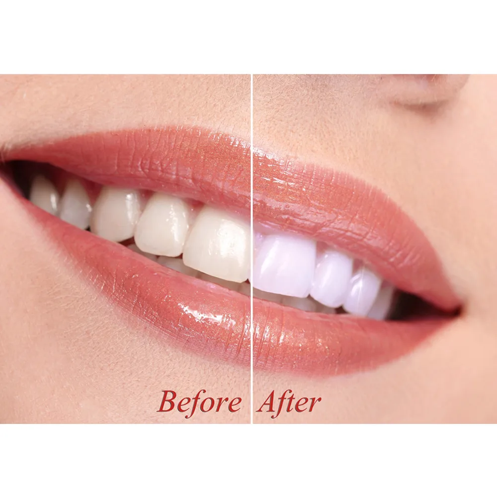 customized  dental oral teeth tooth whitening whitener remove smoke yellow stains bleach gold press pen with box