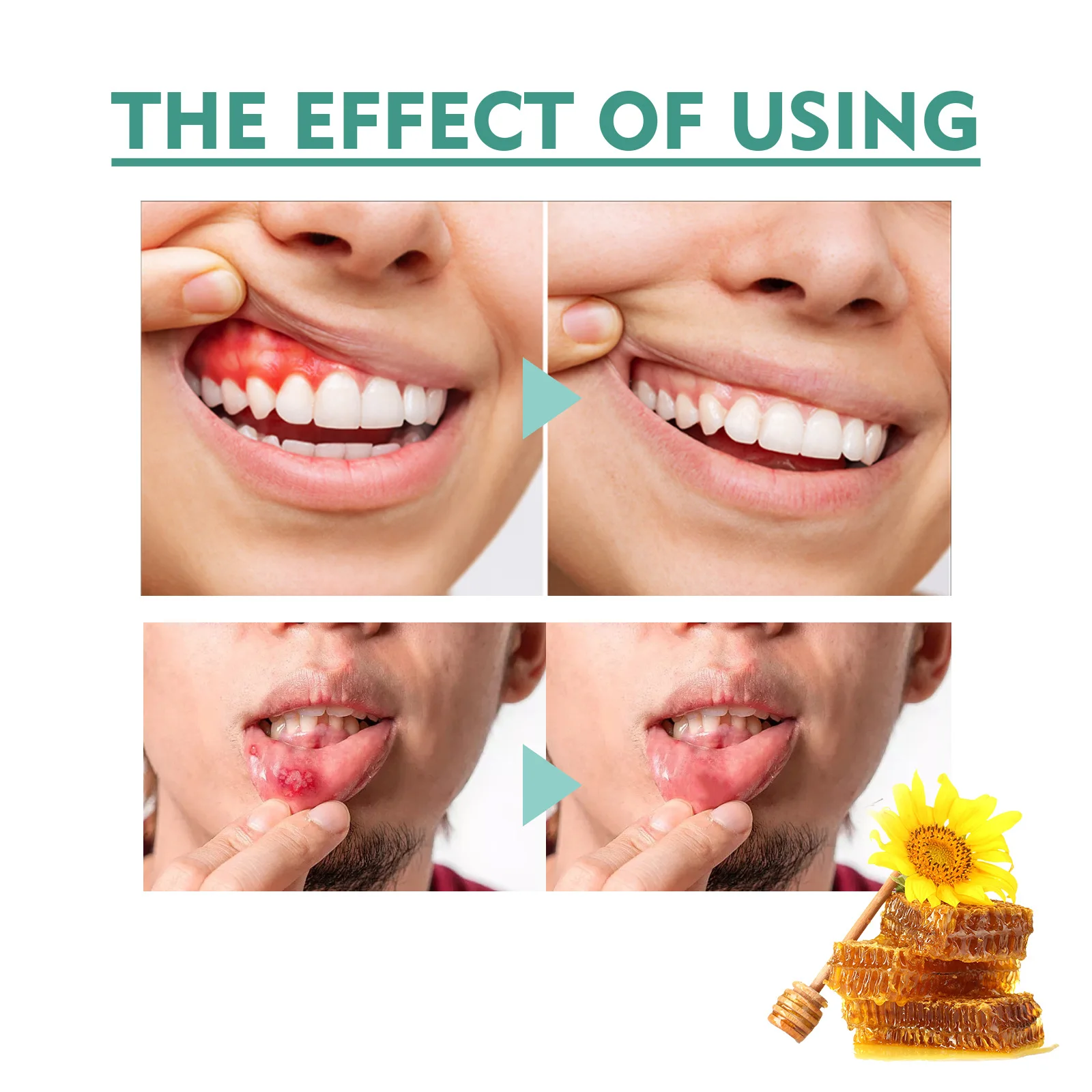 Relieve Toothache Oral Pain Periodontal Gum Pain Aphthous Ulcers Blistering with This Antibacterial Oral Care Spray Solution