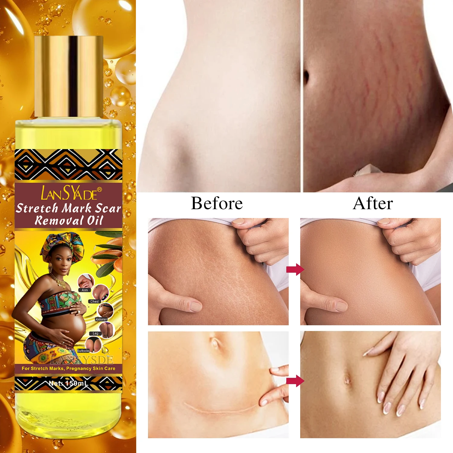 High Quality Pure Stretch Marks Scar Removal Oil Pregnant Scar effective Repair almond oil Stretch Marks Scar Removal Oil