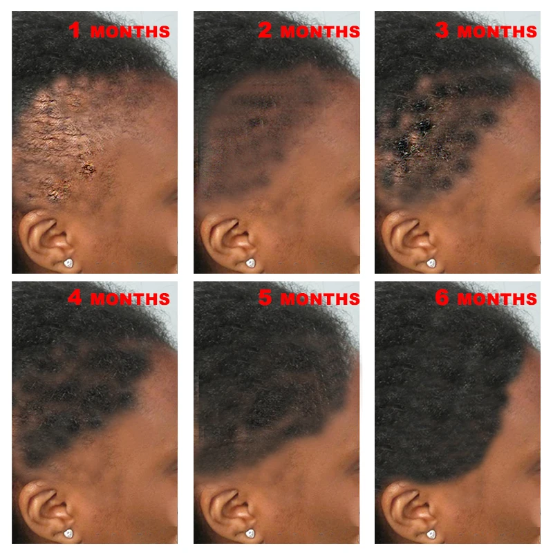 Free Sample OEM/ODM Natural Organic Oil Essential Biotin Serum Hair Growth Oil at Home For Men And Women