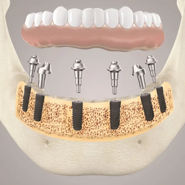 WEGO China Surgic dental implant Dental implant pure titaniumdental implant korea compatible SLA coated service