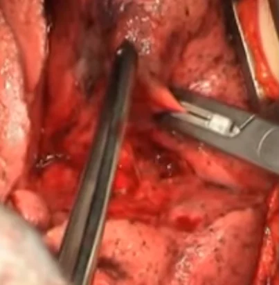 Ligasure vessel sealing device for Force Triad Enegery platform