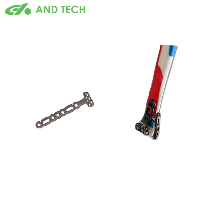 Ортопедическая Дистальная фиксирующая пластина имплантата хорошего качества от китайского производителя