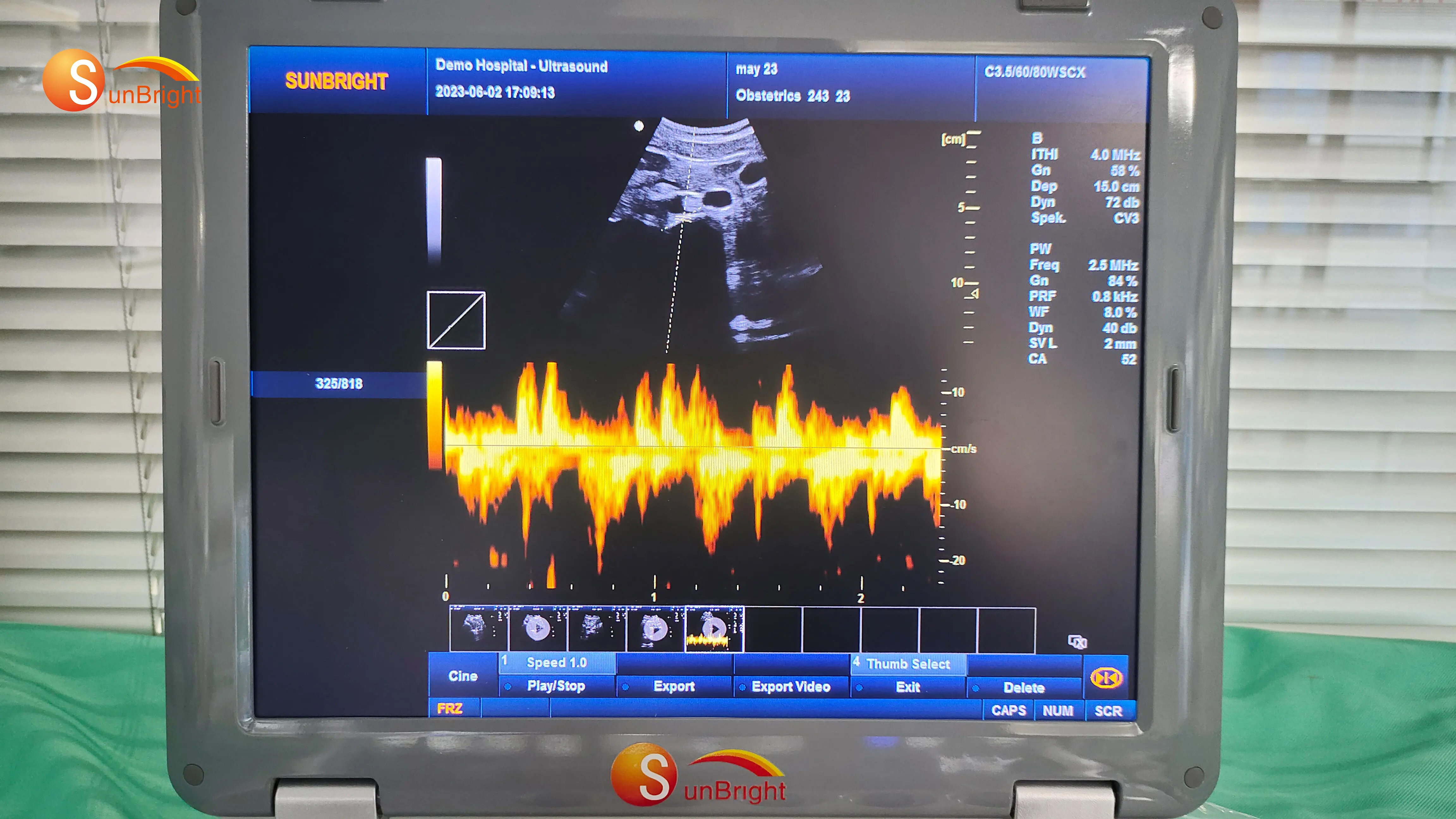 2024 ultrasound scanner 3D pregnancy ultrasonic PW portatil ultrasound model