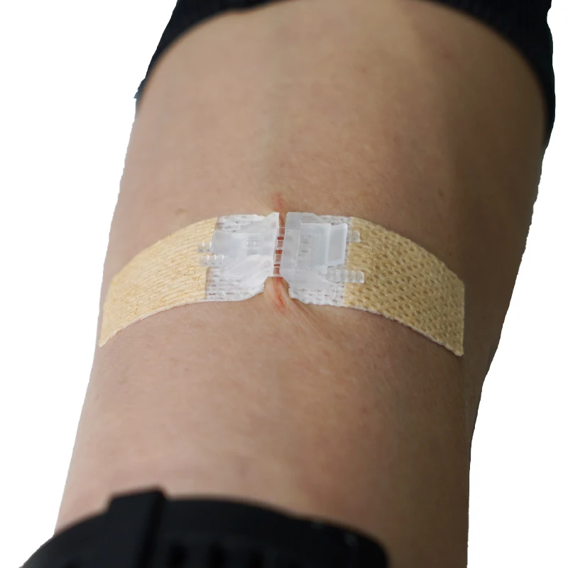 medical wound closure device non-invasive suture skin surface stapler zip stitch