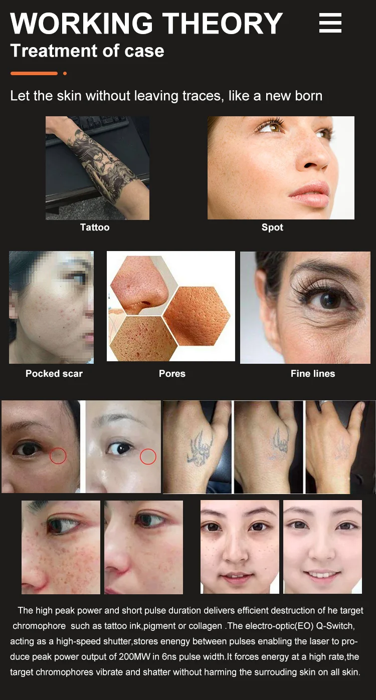 2024 q switched Pigment Removal 755nm picosecond switch Q nd yag laser tattoo removal machine