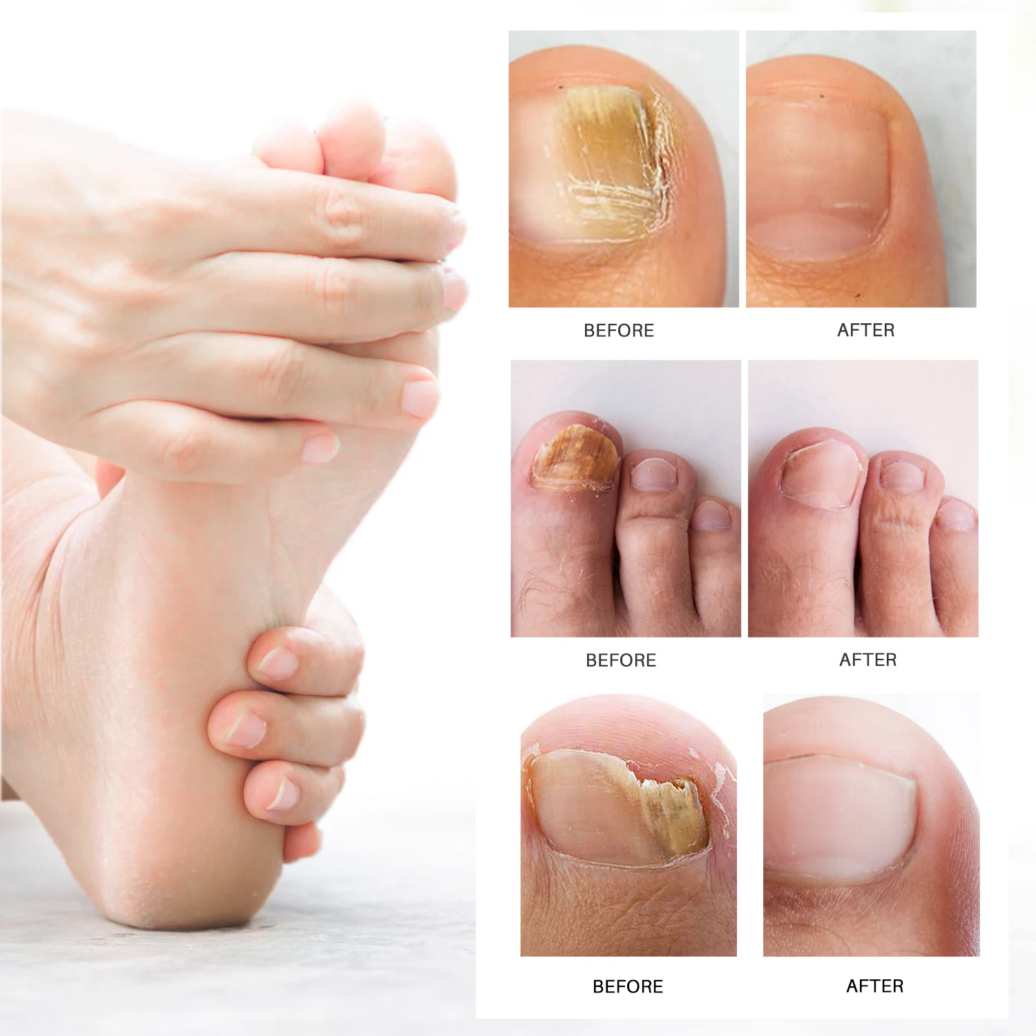 Lanthome Nail Fungus Removal Cream Onychomycosis Fungal Treatment Paronychia Anti Infection Feet Toe Fungal Care Ointment