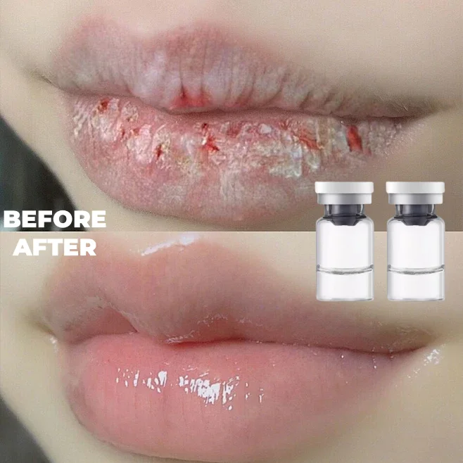 Oem Melasma пилинг с салициловой кислотой для коррекции темных пятен кожи Аква раствор химический лица профессионал