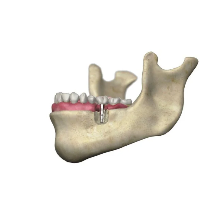CAD Cam Designed Lab Dental Zirconia Implant Crowns and Bridge Over Titanium Bar