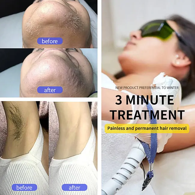 2023 New design Support customization laser diodo 755nm 808nm 1064nm diode laser hair removal machine