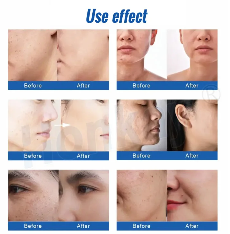 Factory price water dermabrasion skin repair aqua jet peel facial machine