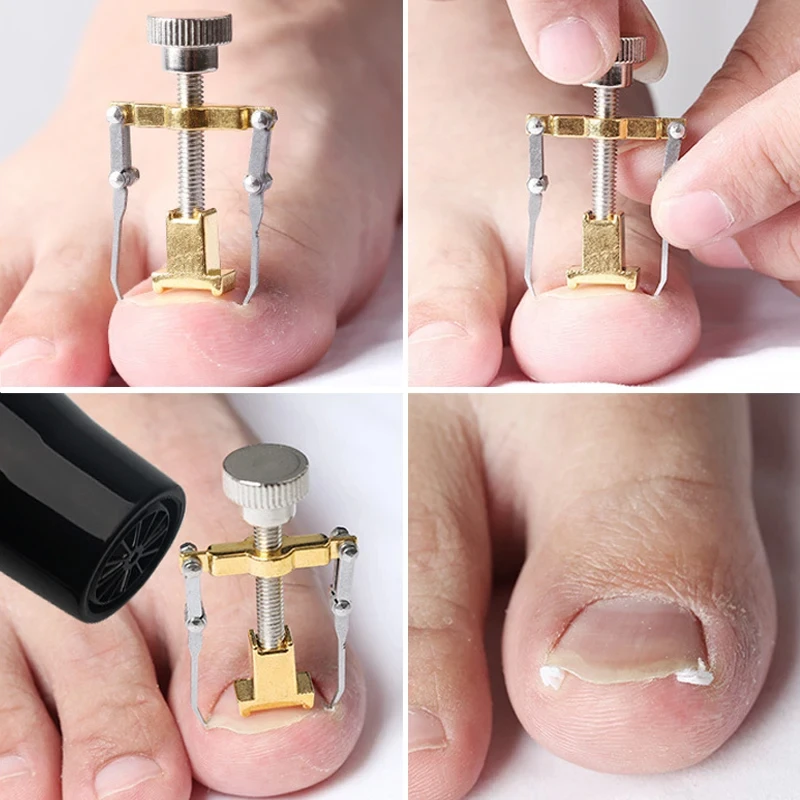 Ingrown Toenail Correction Brace Kit Professional Toe Nail Care Pedicure Manicure Clipper Fixer Recover Corrector Tool