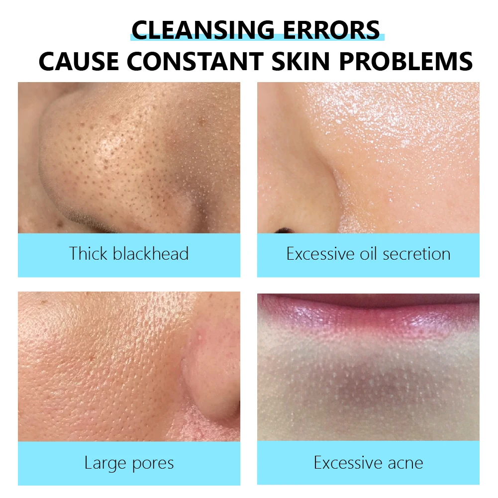 VIBRANT GLAMOUR  Acne Treatment Pore Anti-Aging Dark Spot absorb excess oil Soothe acne shrink pores Blackhead whitehead remover