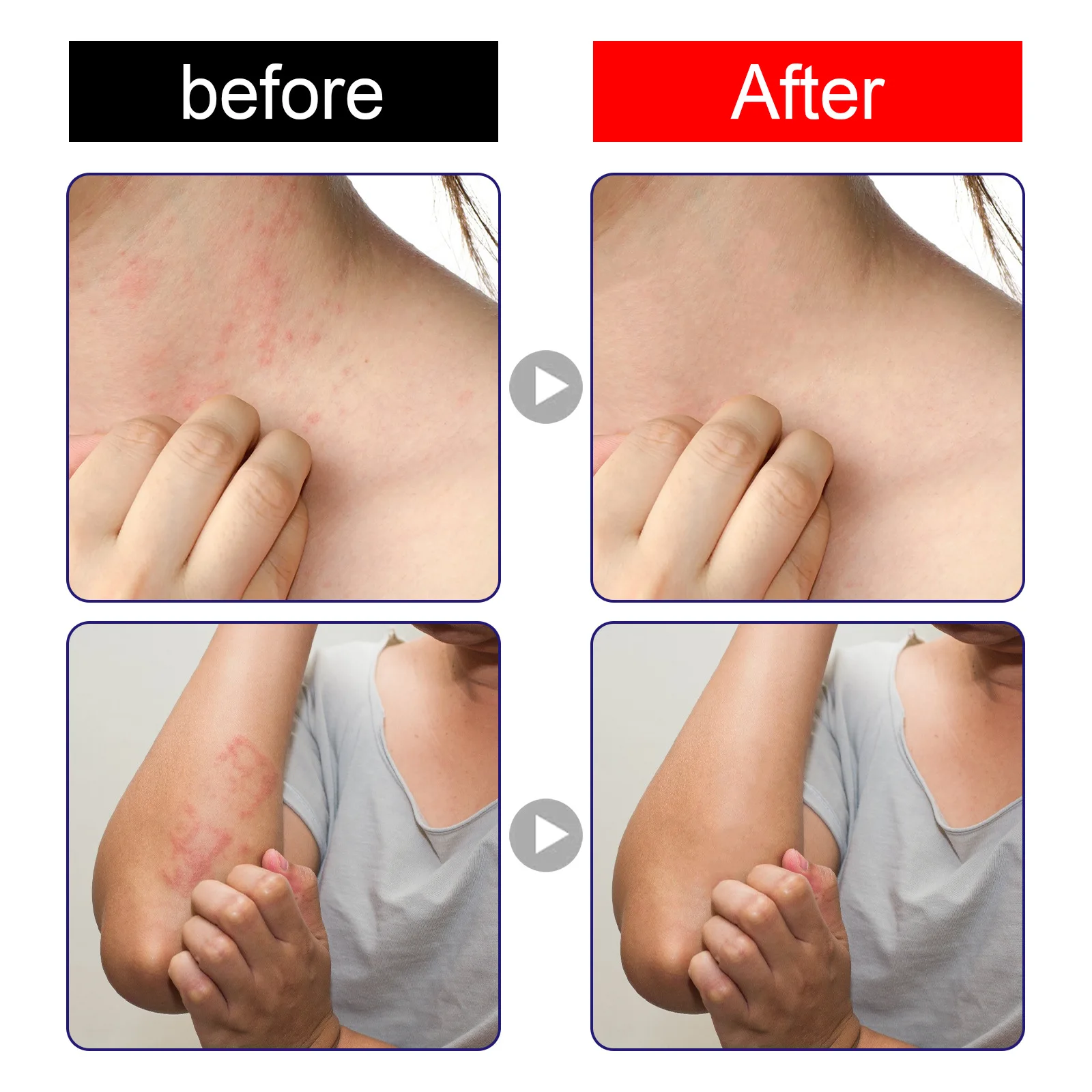 Natural Organic Psoriasis Cream Dermatitis Eczema Treat Ointment Mosquito Bites Allergies Anti-Itch Cream 30g