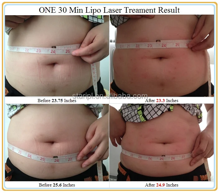 Mini Portable 6d Lipolaser Body Slimming Liposuction Laser 210mw High Power Diode Laser Lamp Lipo Laser 5D Paddle Weight Loss