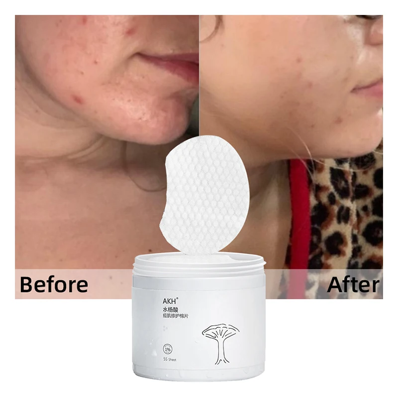 Solution Organic Ordinary Acne Patch Salicylic Supplier Ice Facemask Price Skin Care Private Label Salicylic